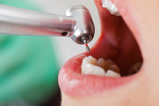 Best Emergency Tooth Extraction in Knoxvle, IL